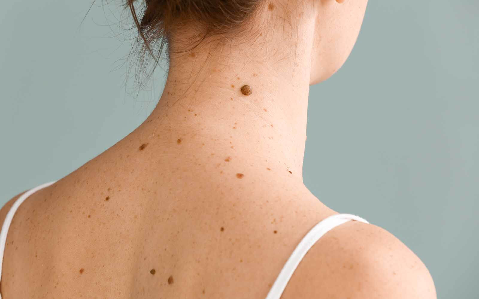 Mole Removal surgery in Belgravia with Jonathan Dunne