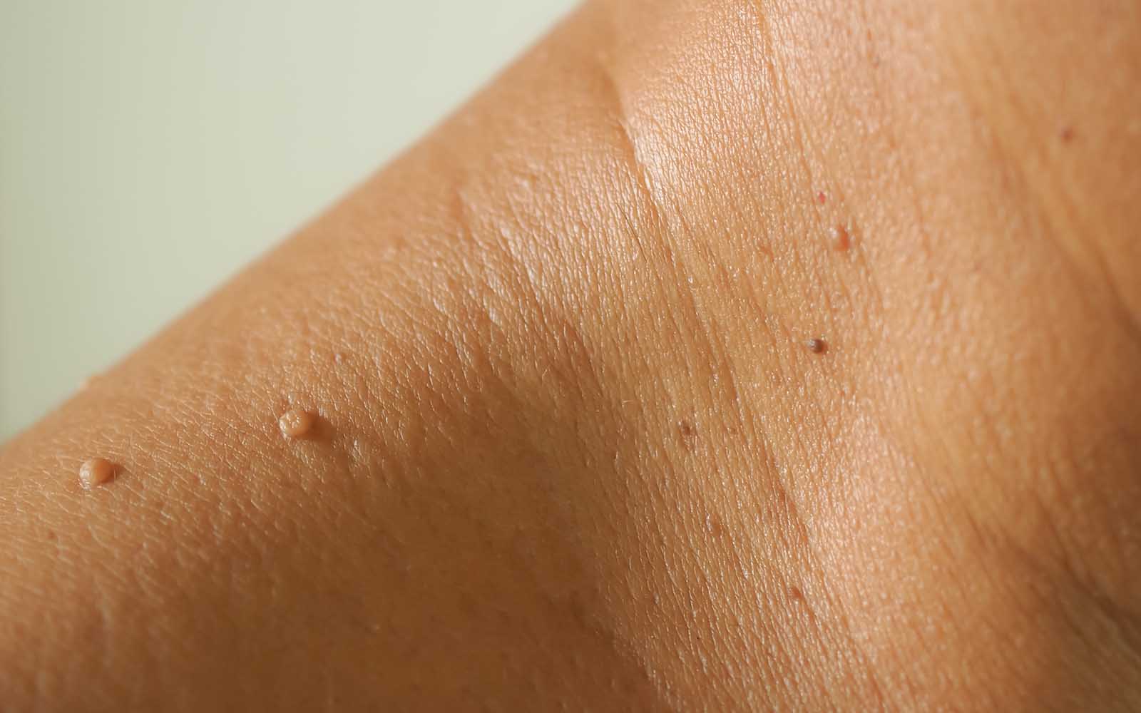 Skin Tag Removal with Jonathan Dunne in Belgravia
