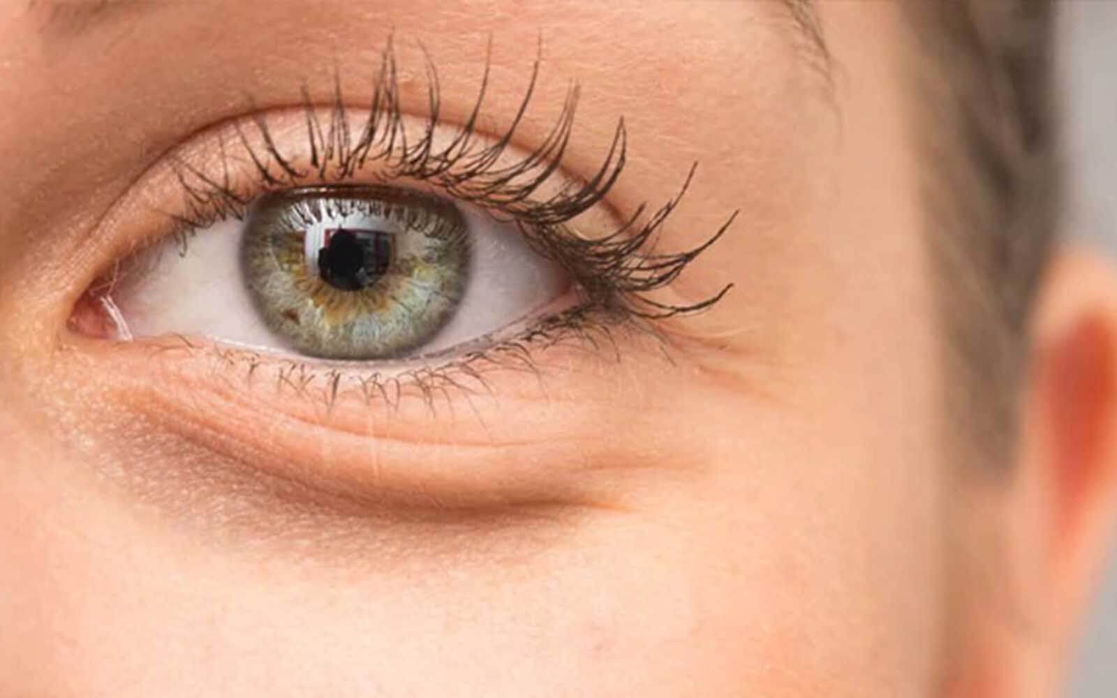 Upper Blepharoplasty treatment in Belgravia with Jonathan Dunnne
