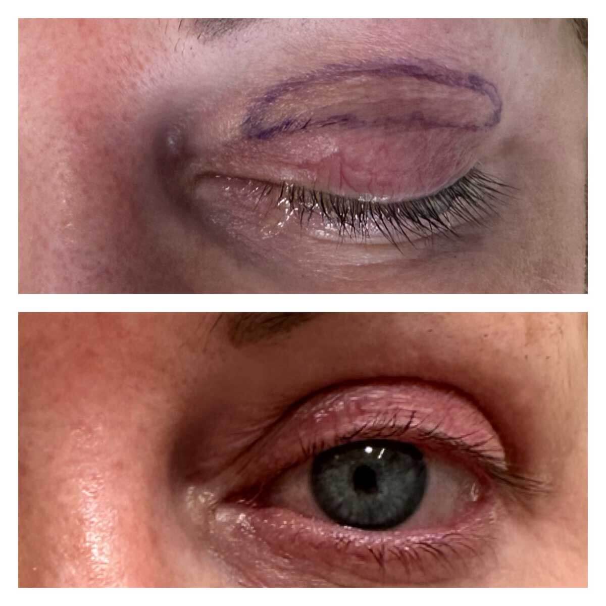 Before and after image of blepharoplasty treatment