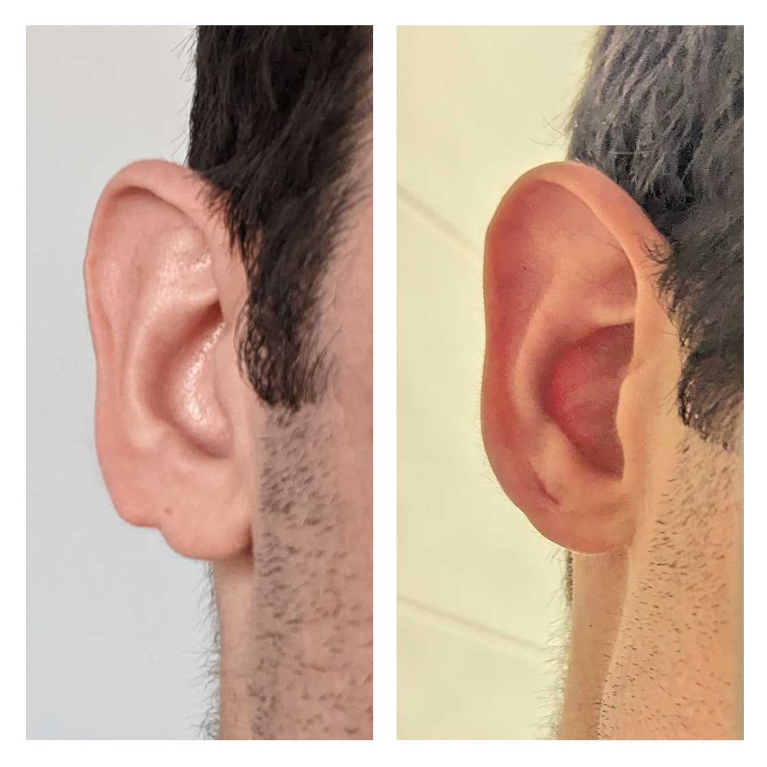 Split Earlobe Repair treatment