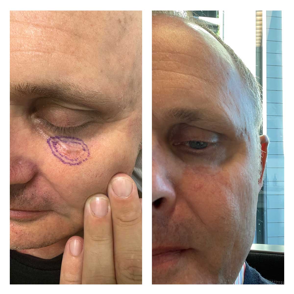 Eyelid Reconstruction before and after