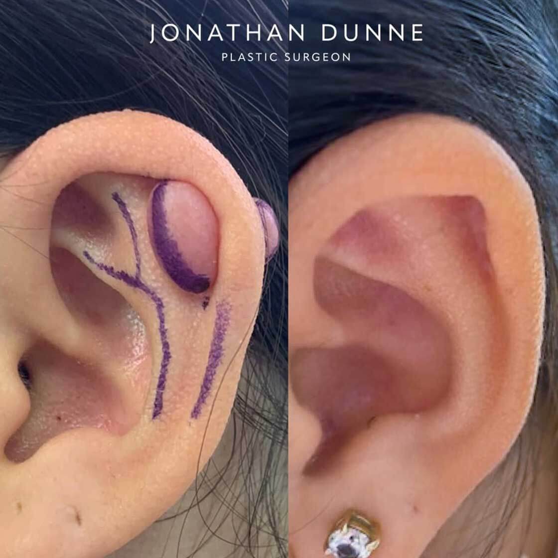 ear keloid treatment in belgravia