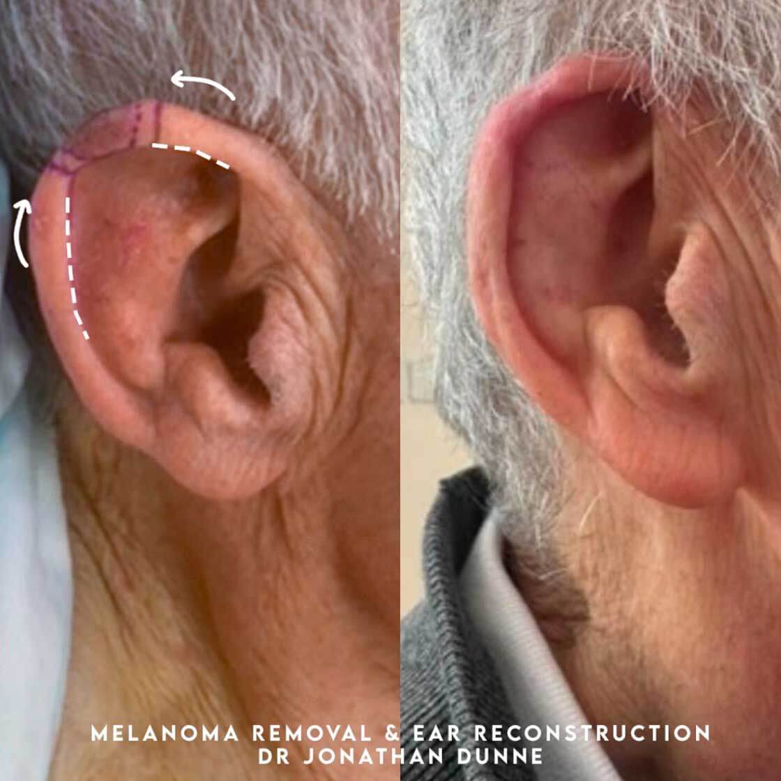 Ear Reconstruction treatment before and after in Belgravia