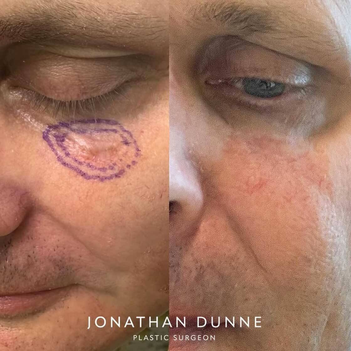 Eyelid Reconstruction before and after in Belgravia with Jonathan Dunne