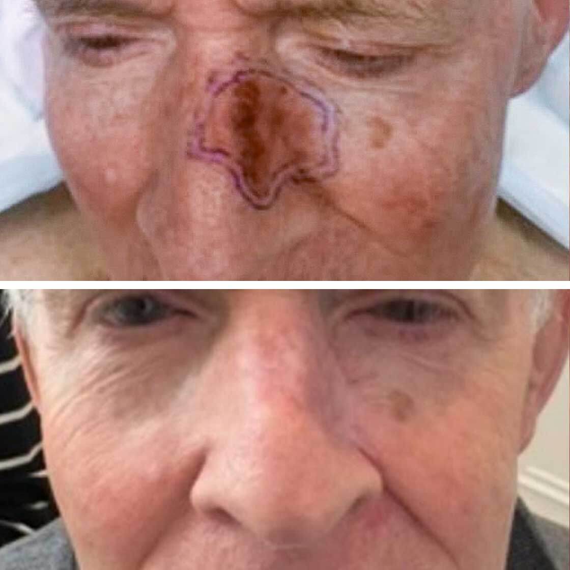 Melanoma treatment before and after in Belgravia