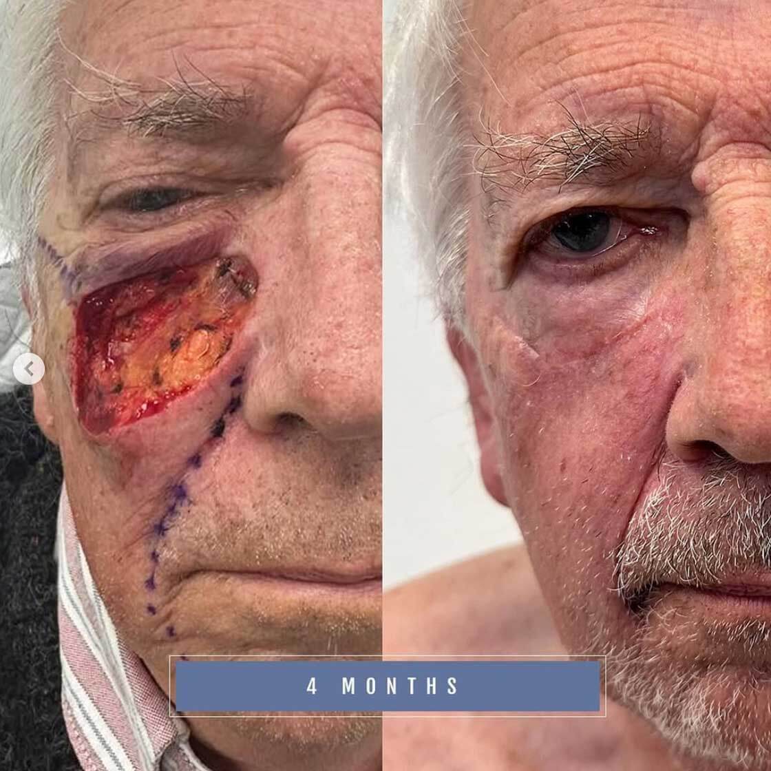 Mohs Surgery Reconstruction before and after in Belgravia
