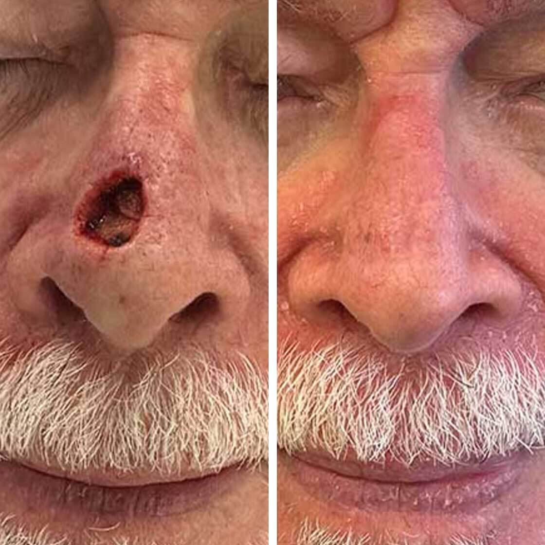 Nose Reconstruction before and after in Belgravia