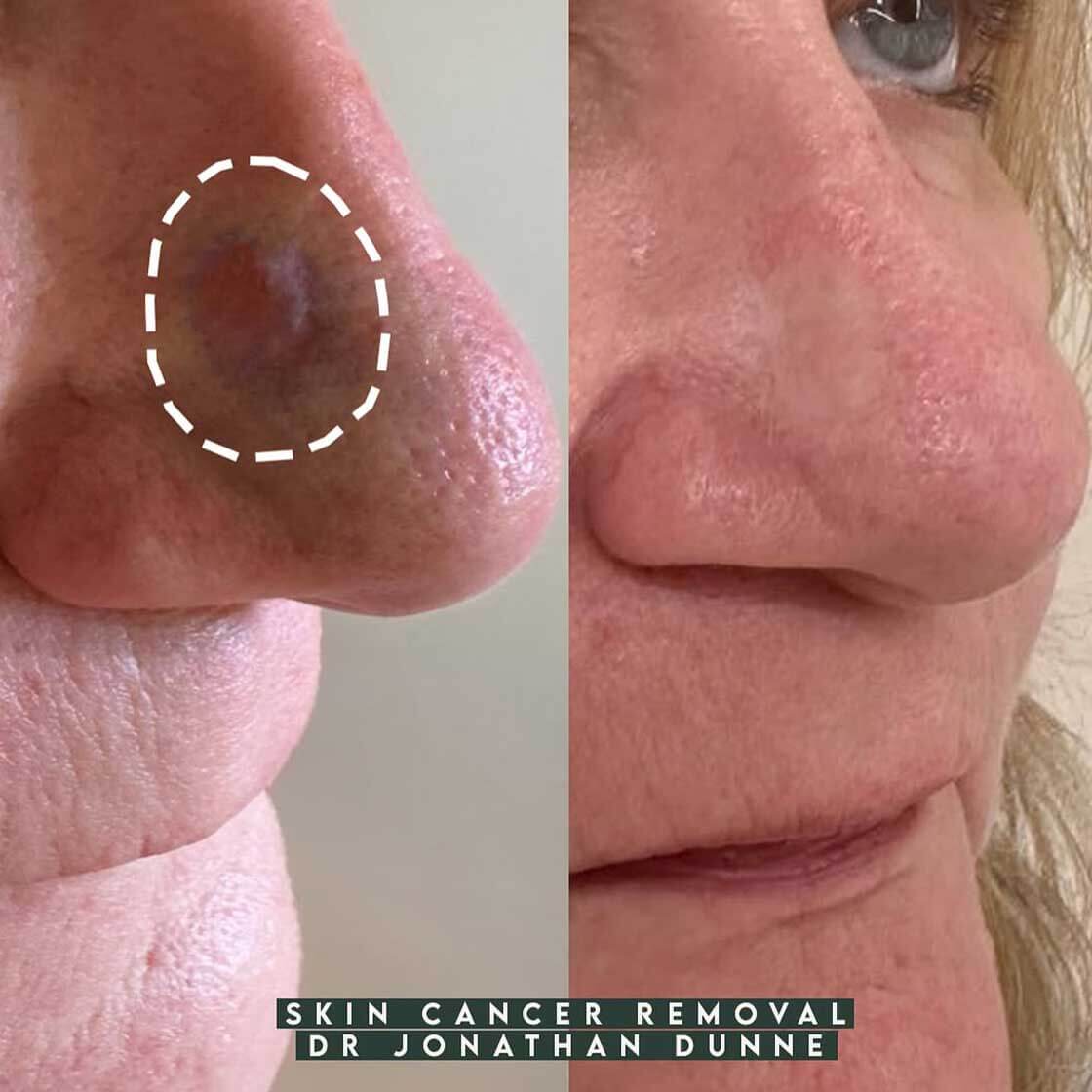Squamous Cell Carcinoma (SCC) before and after image in Belgravia with Jonathan Dunne