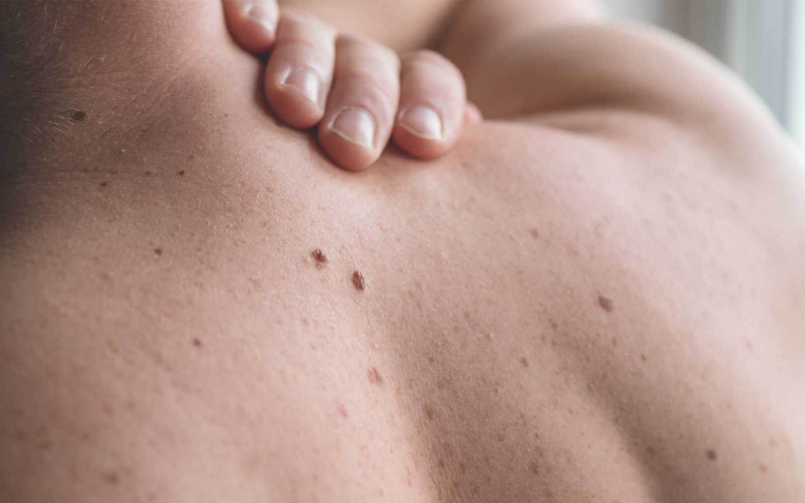 Persons back with moles on the skin