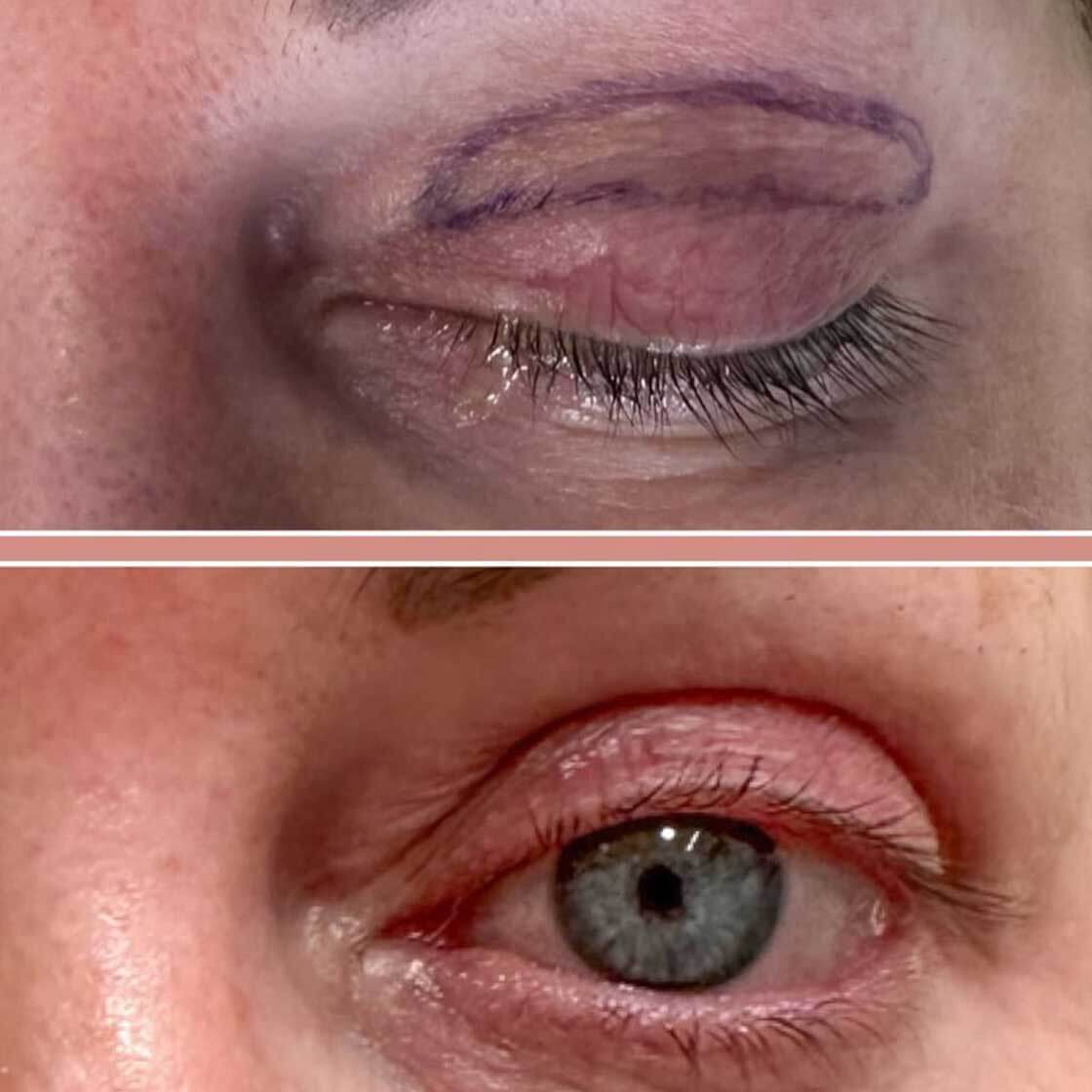 Upper Blepharoplasty treatment with Jonathan Dunne