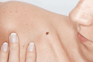 Person with a mole on their collar bone