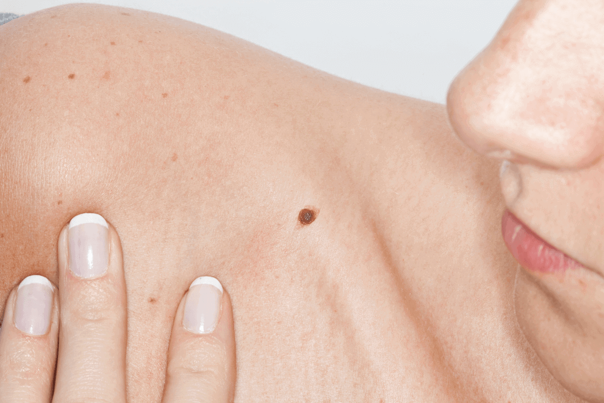 Person with a mole on their collar bone