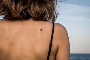 FAQs on Mole Excision