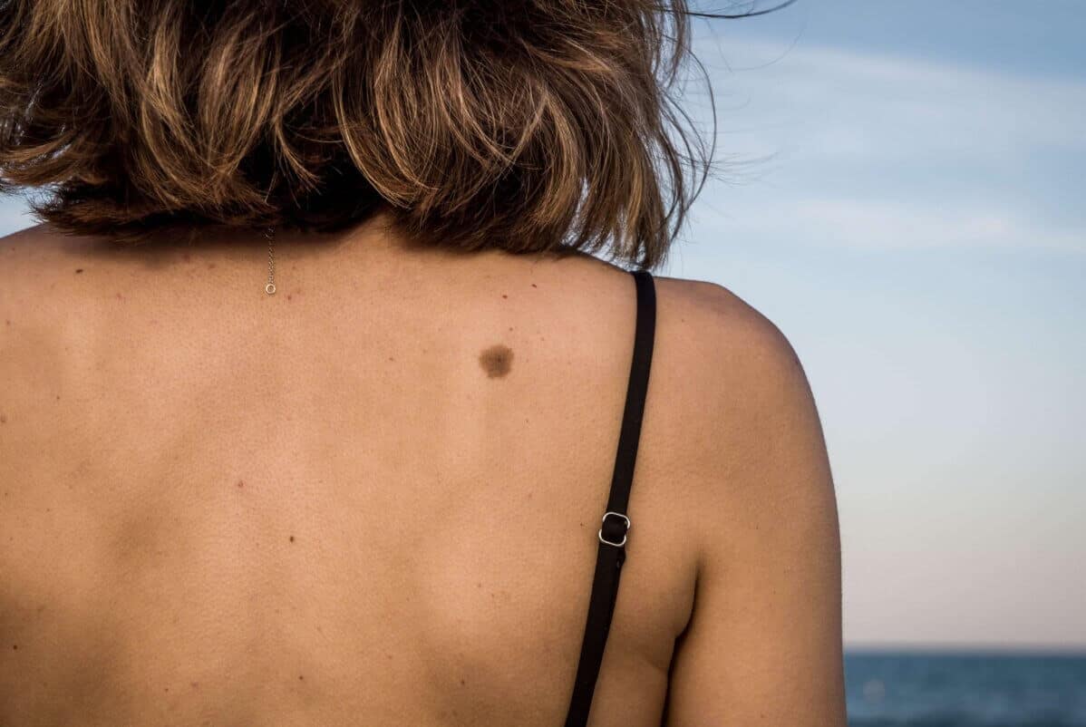 FAQs on Mole Excision