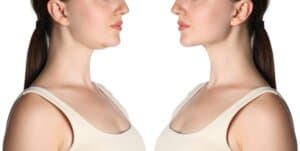 Facelifts and the Heavy Neck: A Targeted Surgical Approach