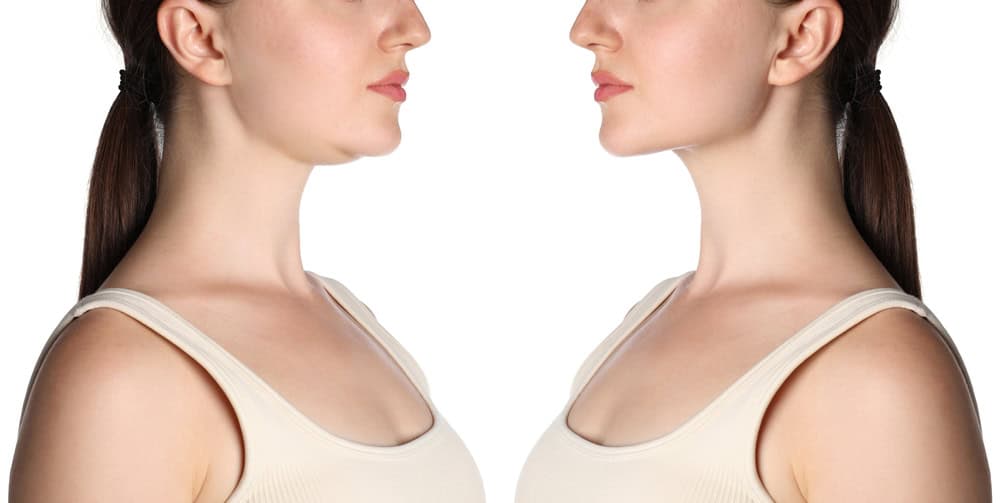Facelifts and the Heavy Neck: A Targeted Surgical Approach