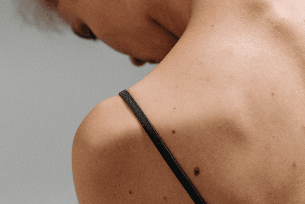 Woman with moles on her back